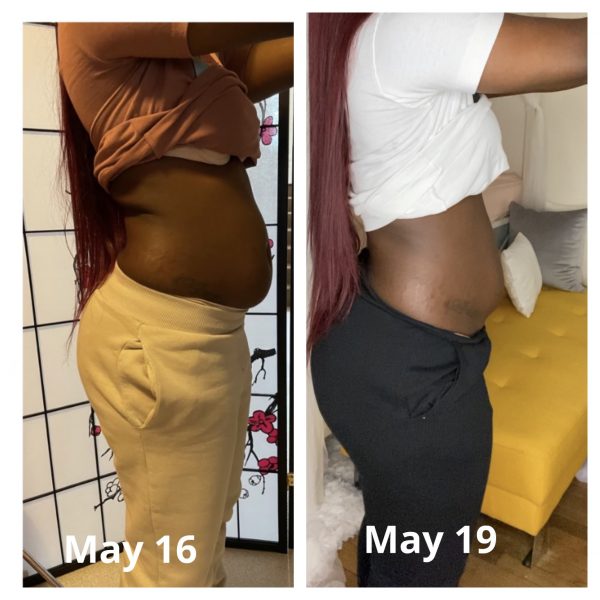 Bulge be gone ( fat dissolve) single session